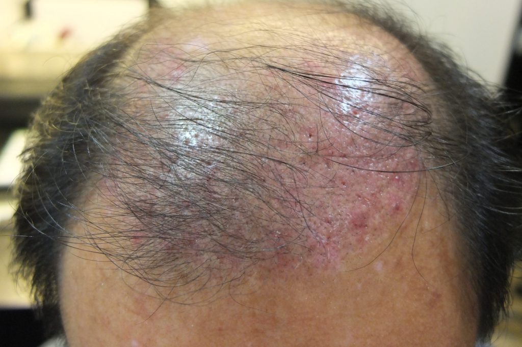 Fig. 1 Traumatic Folliculitis at Day 18