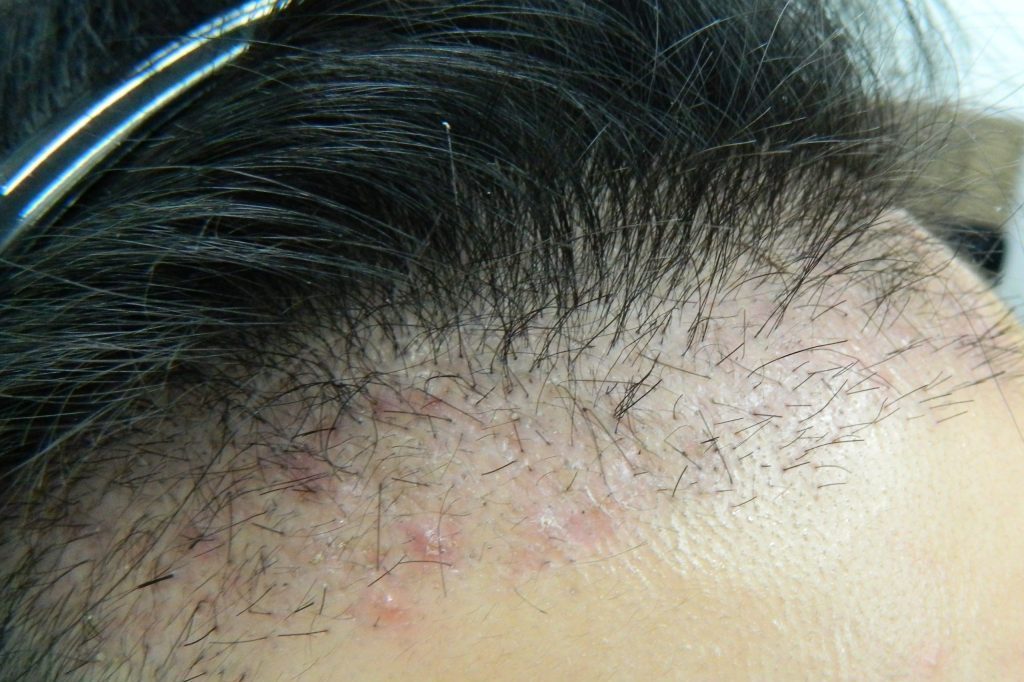 Fig.2 Foreign Body Folliculitis at 4 weeks